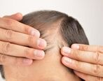 داروهای ریزش موی مناسب کدامند؟ چگونه ریزش مو را درمان می‌کنند؟
