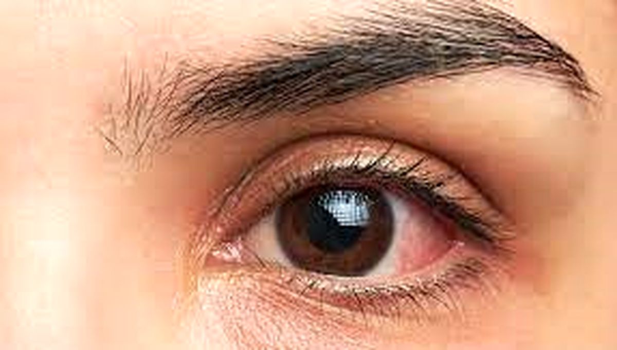 تکنیکی برای جلوگیری از خشتگی چشم