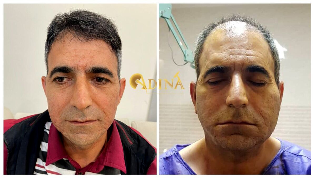 بهترین روش کاشت مو با تراکم بالا برای افرادی با بانک موی ضعیف