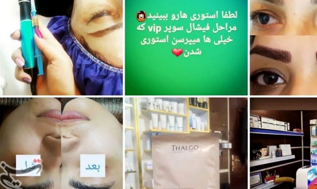  جراحی صورت دختر تهرانی را خراب کرد| زشت شدن یک شبه این دختر!