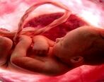 غربالگری جنین با شرایط جدید اعلام شد