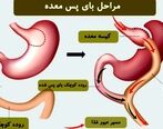 بای پس معده چیست؟