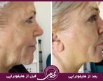 هایفوتراپی صورت بهترین روش غیر تهاجمی جوانسازی پوست! 20 سال جوانتر شوید!