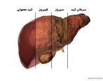 علائم بیماری کبد چرب را بشناسید