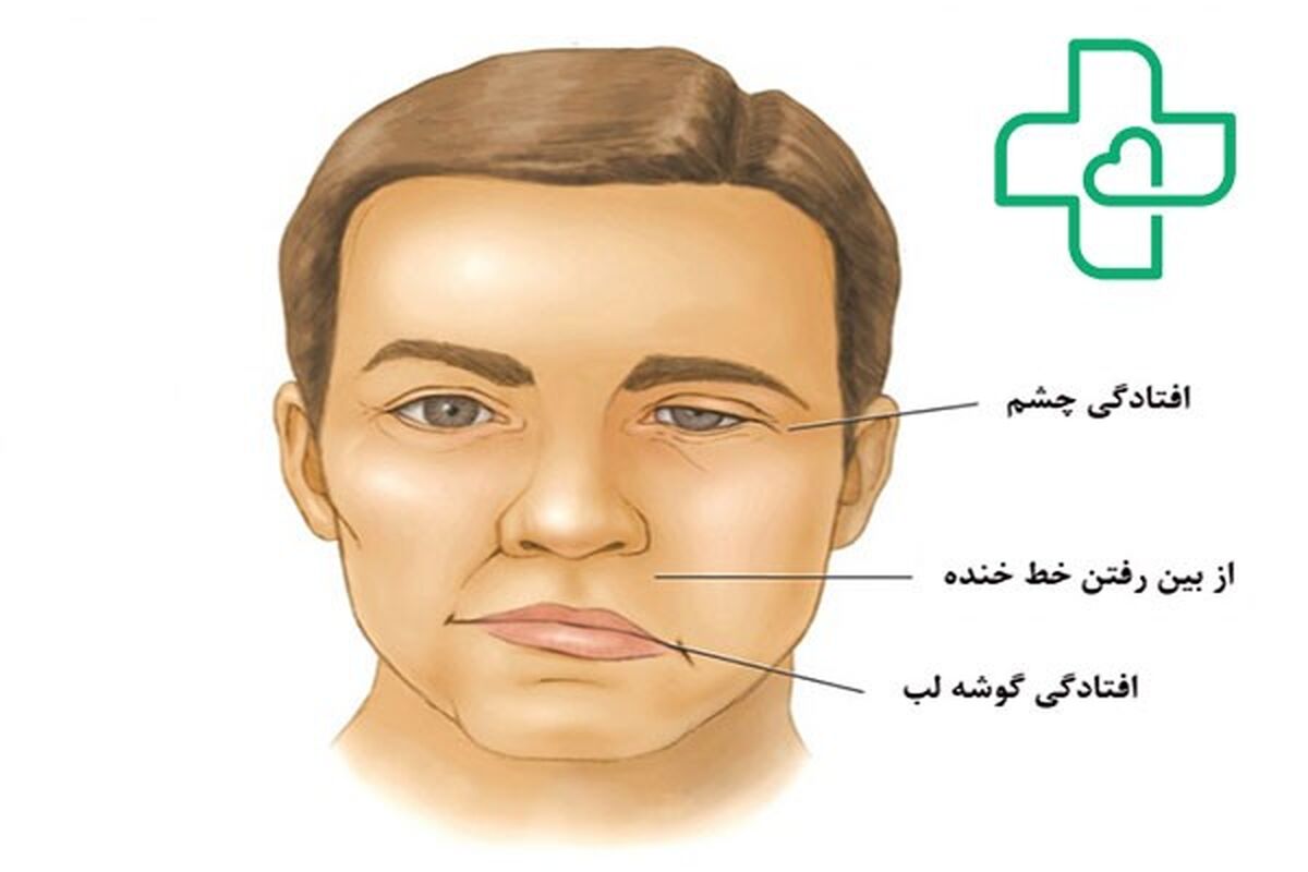 فلج کلی یا تتراپلژی چیست؟ علائم + درمان