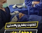 عمل بلفاروپلاستی تحت نظر بهترین پزشکان ایران- کلینیک vip