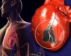 معجزه درمان برای جلوگیری از سکته قلبی + ویدئو 