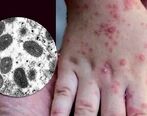 همه گیری آبله میمون هشدار آمیز شد؟ | پیش‌بینی از آینده آبله میمونی