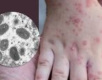 همه گیری آبله میمون هشدار آمیز شد؟ | پیش‌بینی از آینده آبله میمونی