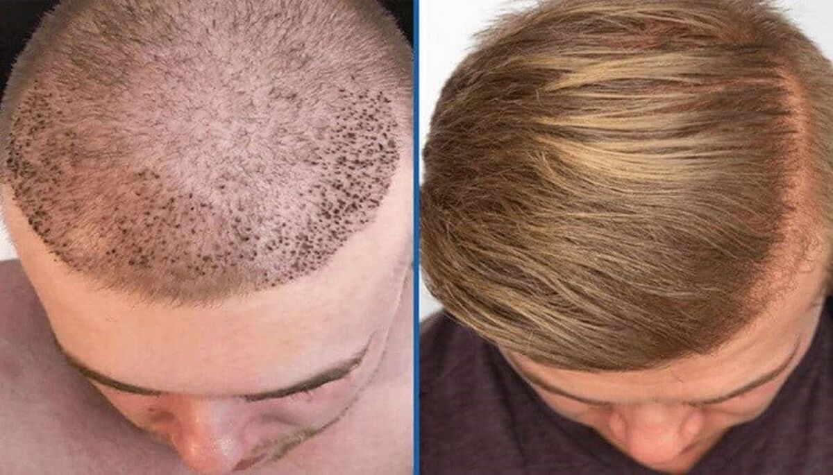 مزایای کاشت مو به روش FUT چیست ؟