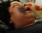 آمار رو به افزایش مبتلایان به قارچ سیاه در این استان