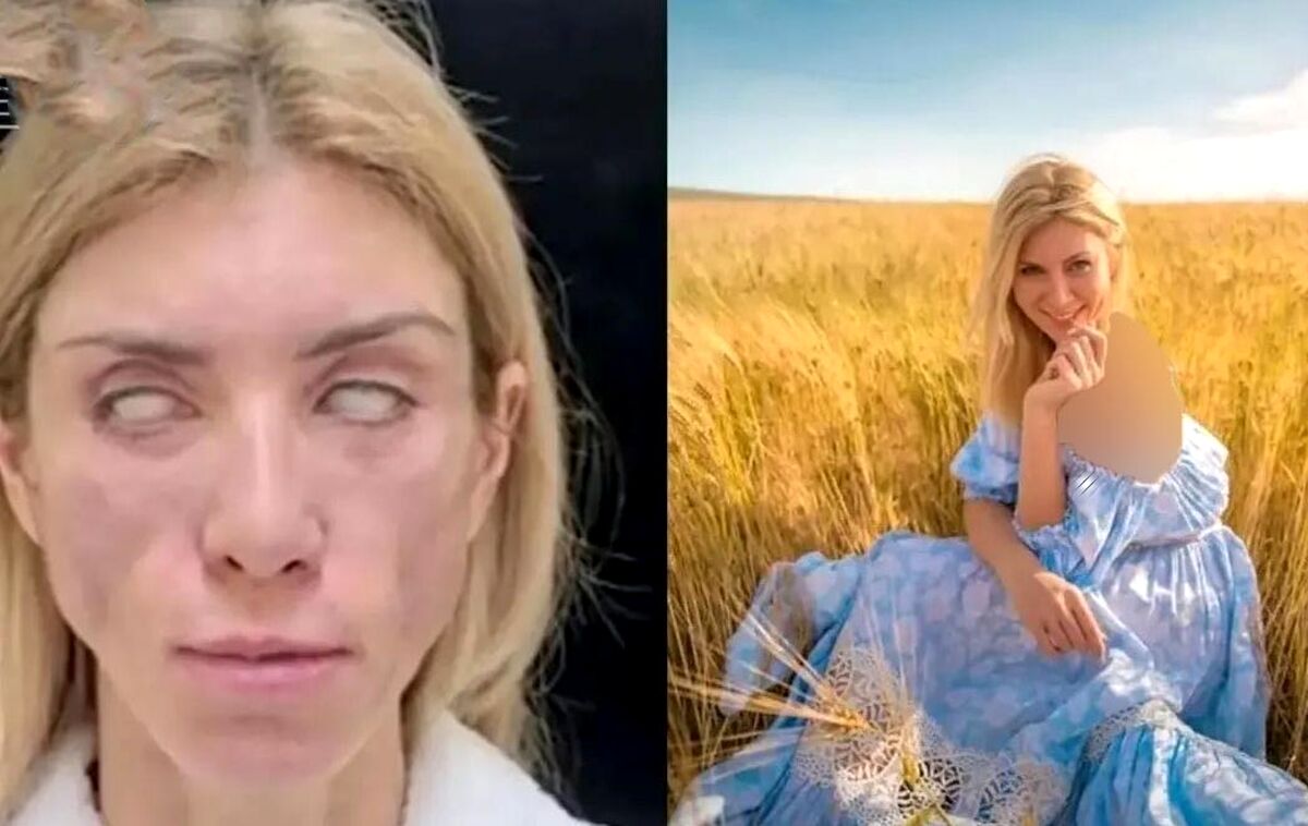 صورت ملکه زیبایی روس نابود ش| عکس های باورنکردنی
