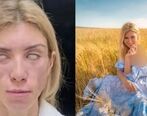 صورت ملکه زیبایی روس نابود ش| عکس های باورنکردنی