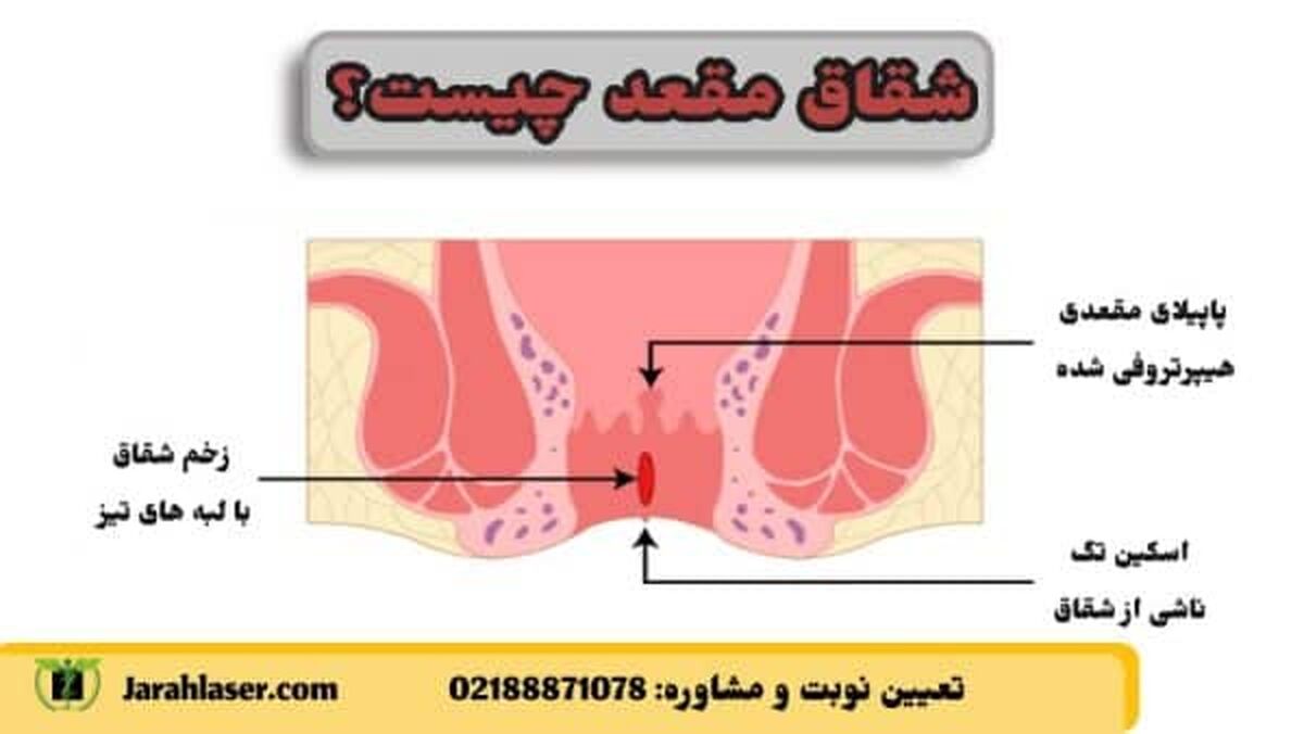 زخم مقعد در اثر یبوست نشانه چیست و چگونه درمان میشود؟